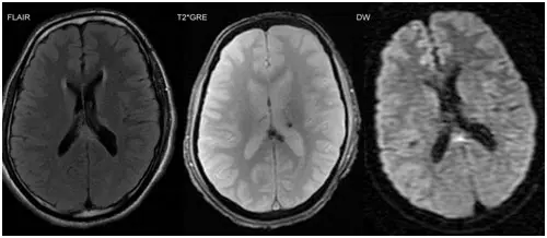 TRAUMATIC BRAIN INJURY (TBI)