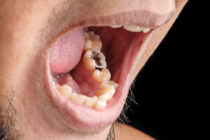 Suboxone Tooth Decay Lawsuit - The Russo Firm